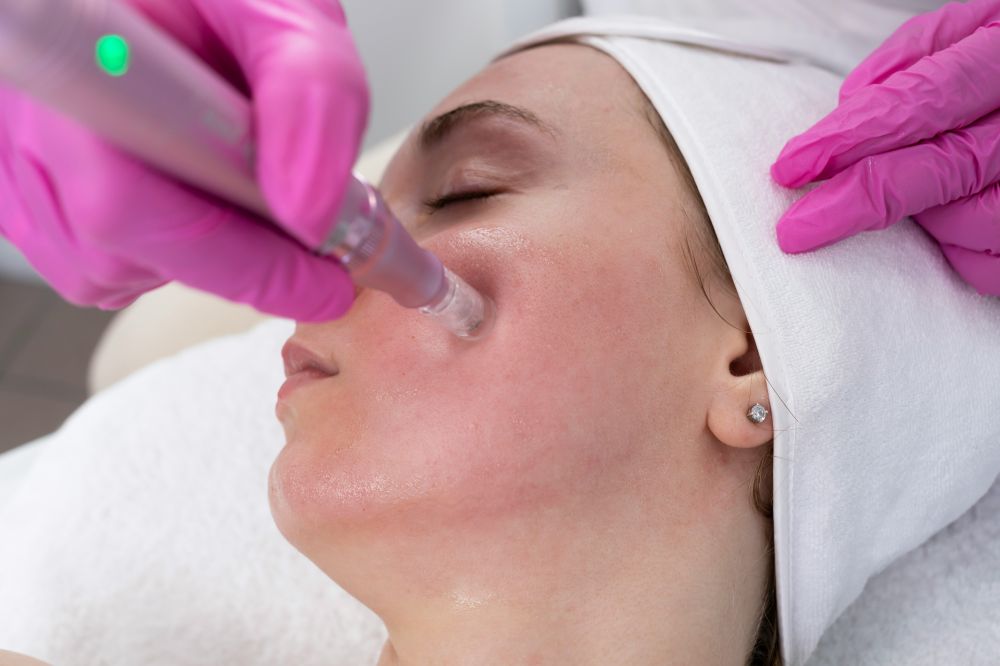 Microneedling i Bergen: En komplett guide till naturlig hudfornyelse